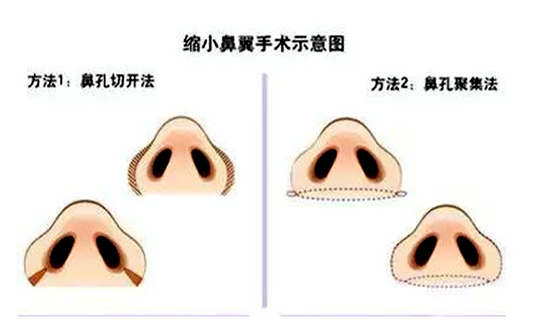  鼻翼縮小有后遺癥嗎？會不會反彈