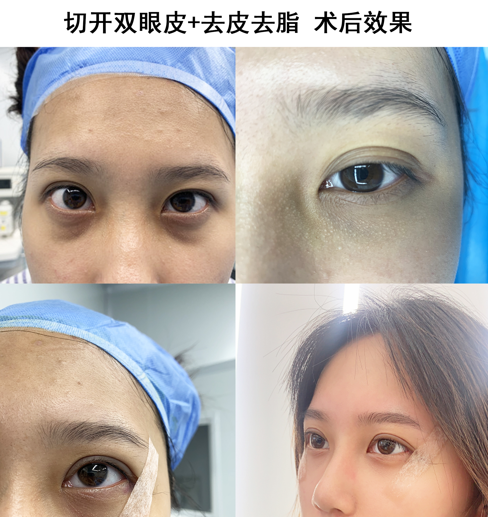 割雙眼皮