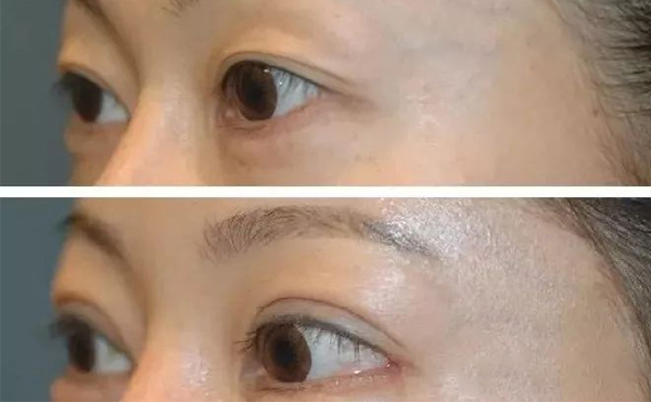 開外眼角需要多久恢復(fù)？