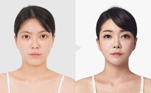 韓式埋線雙眼皮多久恢復自然？