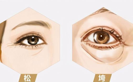 無(wú)痛去眼袋價(jià)格多少錢？