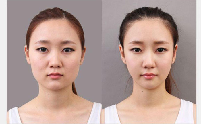 非手術(shù)瘦臉多少錢？非手術(shù)瘦臉方法有哪些？