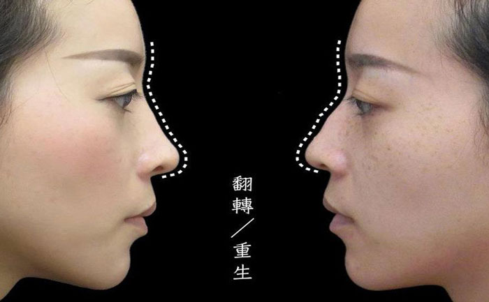 駝峰鼻矯正手術(shù)多少錢？駝峰鼻怎么改善？