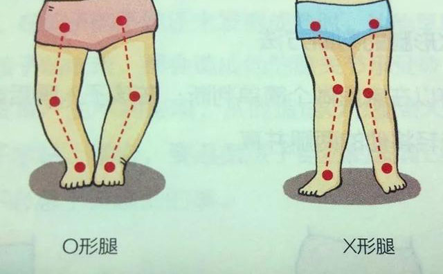 羅圈腿怎樣矯正？羅圈腿手術(shù)矯正多少錢？