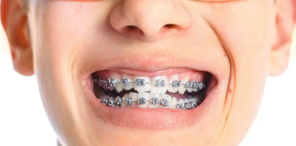 牙齒矯正的最好方法是什么？