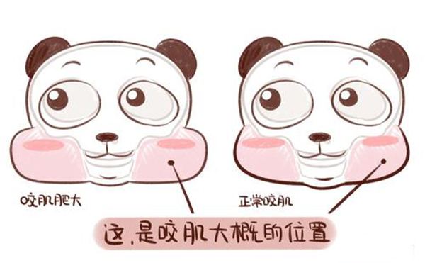造成咬肌肥大的原因是什么？