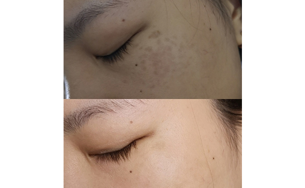 激光美白能維持多久？