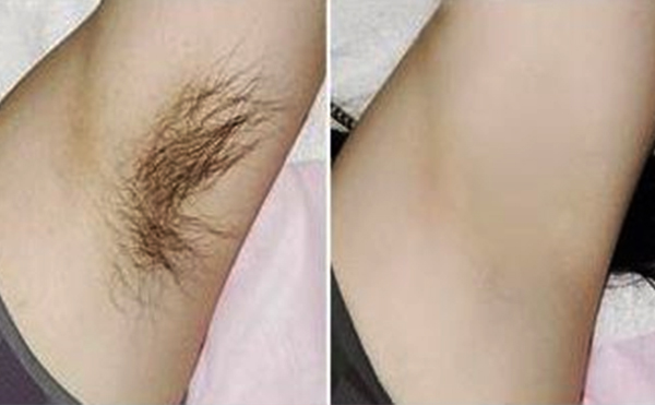 光子脫腋毛有什么優(yōu)勢？