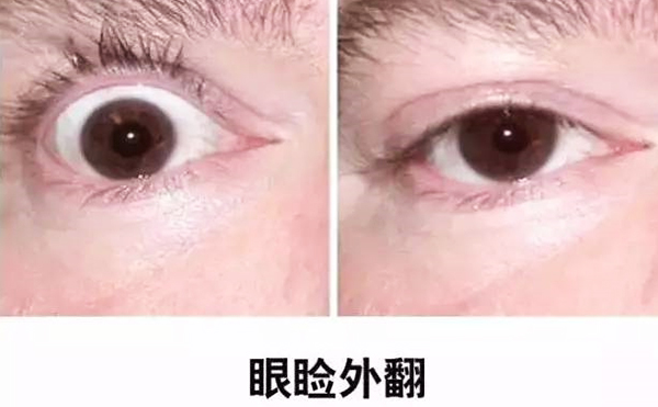 醫(yī)美技術(shù)越來越發(fā)達(dá)，不少愛美的人本著變美的心情滿懷期待地去做雙眼皮、開眼角等項(xiàng)目，不料整容不成、反倒毀容，后悔也來不及。有些做雙眼皮的姑娘術(shù)后出現(xiàn)眼瞼外翻的情況，那眼瞼外翻是什么意思?上眼瞼外翻如何修復(fù)?