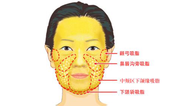面部吸脂有哪些部位？