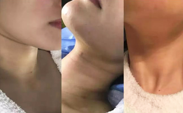 激光去頸紋多少錢？