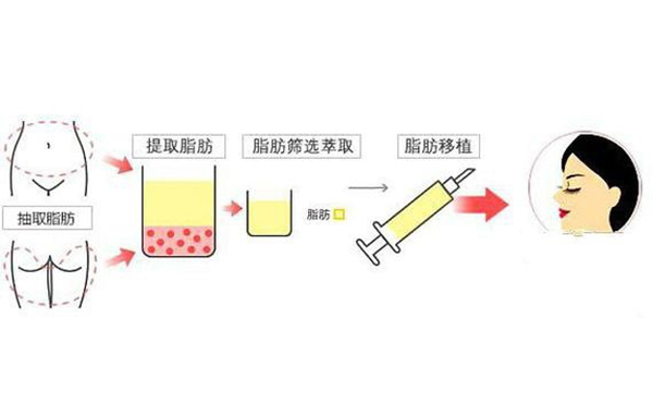 去眼袋后下眼瞼為什么凹陷?去眼袋后下眼瞼凹陷怎么辦?