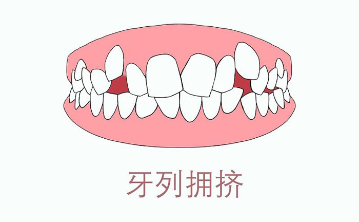 矯正牙齒擁擠度怎么算？