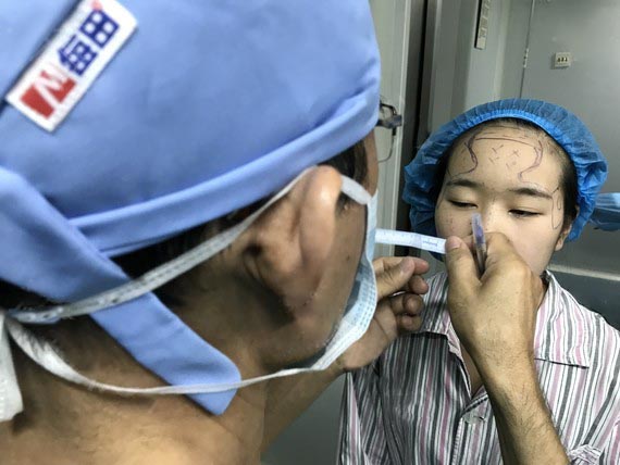 面部填充效果對比圖