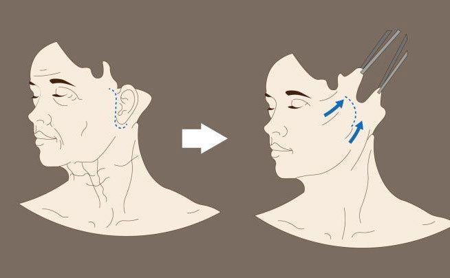 電波拉皮一次大概多少錢？
