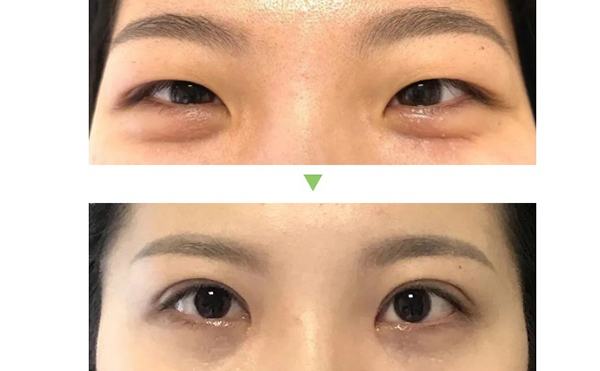 雙眼皮手術(shù)的種類(lèi)及優(yōu)缺點(diǎn)是什么?術(shù)后怎么護(hù)理效果好?