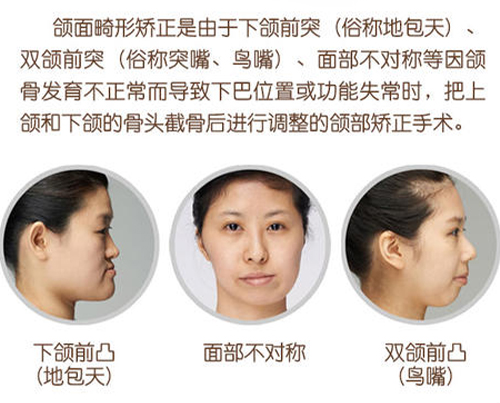 正頜手術真實分享