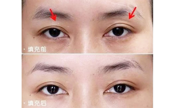 眼瞼凹陷矯正過(guò)程是什么?眼瞼凹陷矯正需要多少錢(qián)?