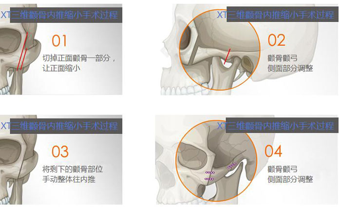 額骨內(nèi)推是什么手術(shù)？