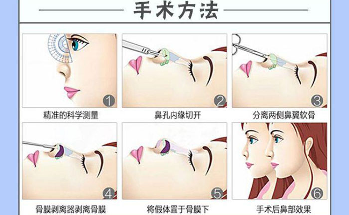 隆鼻假體取出后能恢復(fù)到以前嗎？