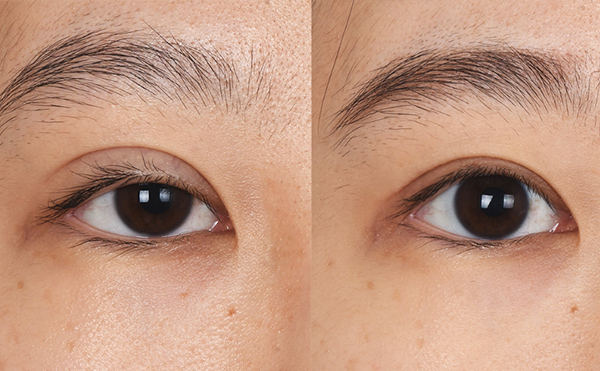 眼部修復(fù)風(fēng)險(xiǎn)大嗎？眼修復(fù)價(jià)格是多少？