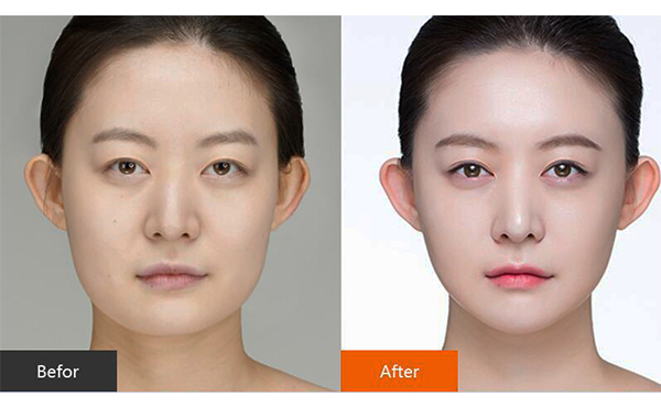 美白針推薦打嗎?有什么副作用?