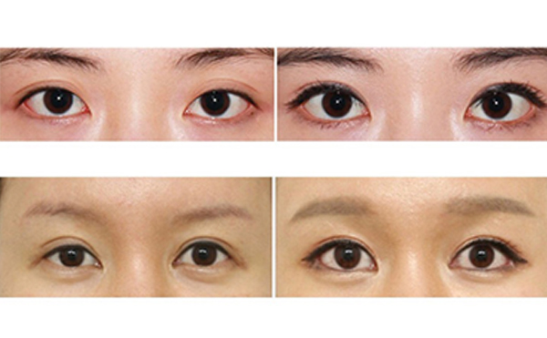 為什么醫(yī)生不建議開外眼角？