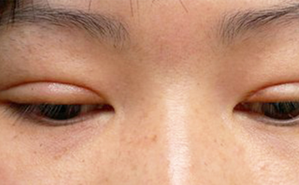 埋線雙眼皮失敗該如何修復？多久修復好？