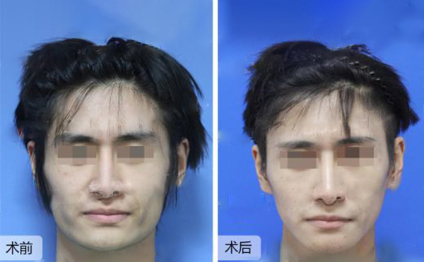 做下頜角整形風險有哪些？