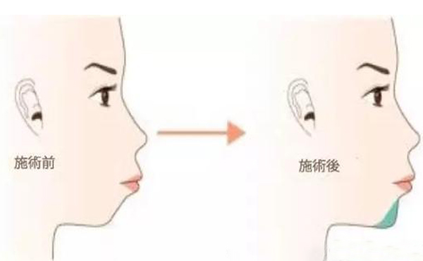 注射愛貝芙墊下巴多少錢?有什么特點?