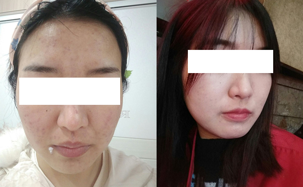 美白針可以維持多久？