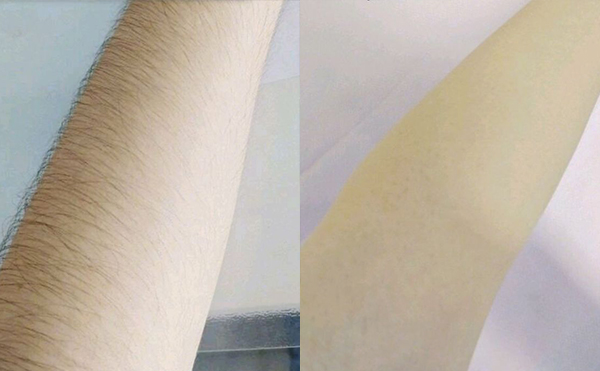 光子脫毛有疼痛感嗎？