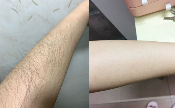 光子手臂脫毛是怎么做的？