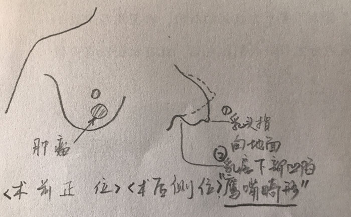 乳房畸形是什么原因造成的？乳房畸形矯正手術(shù)方法？