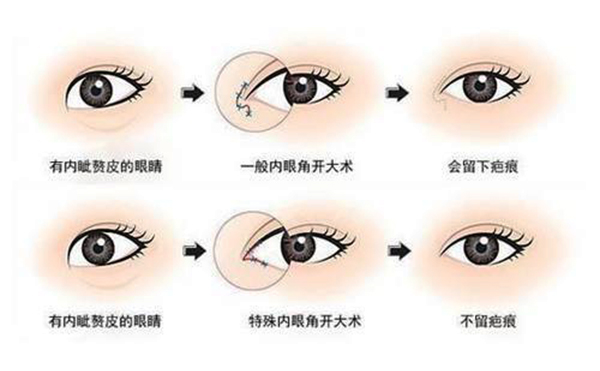 開內(nèi)眼角適合哪些人群?開內(nèi)眼角會(huì)留疤嗎?
