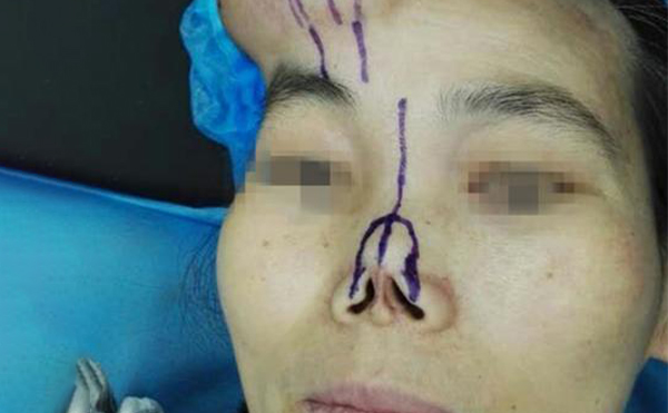 全鼻再造手術(shù)的方法有哪些?手術(shù)前要做什么準(zhǔn)備