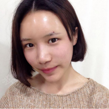 全臉脂肪填充效果對(duì)比圖3