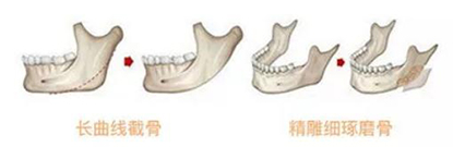 V臉成型術(shù)