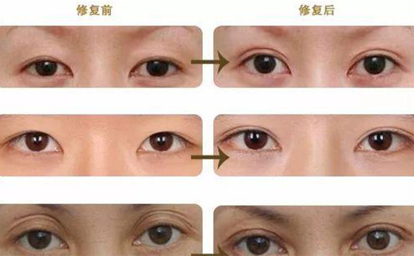 雙眼皮修復(fù)可靠嗎？什么時候做雙眼皮修復(fù)比較好？