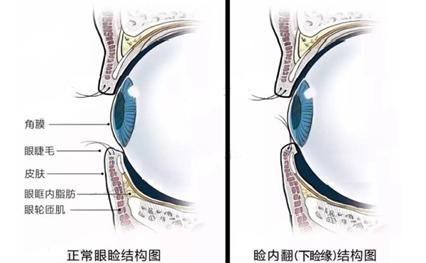 眼瞼內(nèi)翻什么意思?眼瞼內(nèi)翻怎么辦?