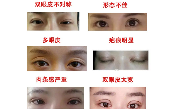 哪些情況需做雙眼皮修復(fù)？修復(fù)難度大不大?