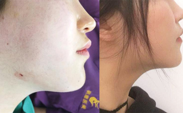 面部吸脂恢復(fù)期多長時(shí)間？