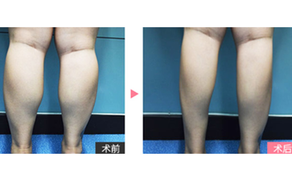 boxo瘦腿有什么優(yōu)勢？
