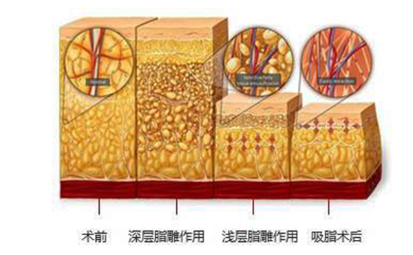 韓式分層吸脂的效果怎么樣？