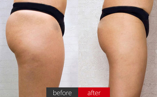 臀部抽脂術(shù)后皮膚會(huì)松弛嗎？
