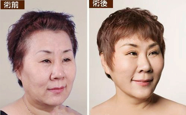 拉皮手術(shù)多久能恢復自然？
