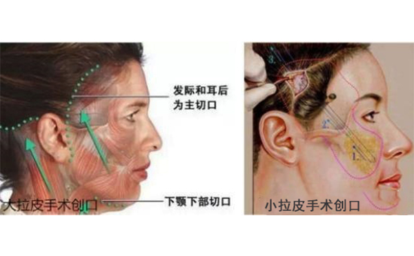 小拉皮和傳統(tǒng)拉皮有什么區(qū)別？