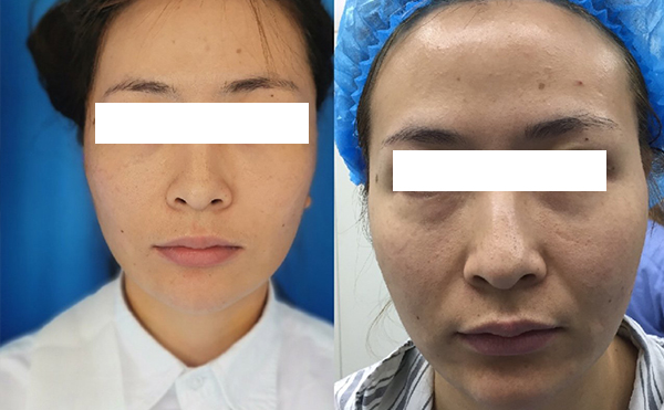 拉皮和線雕哪個(gè)效果好？