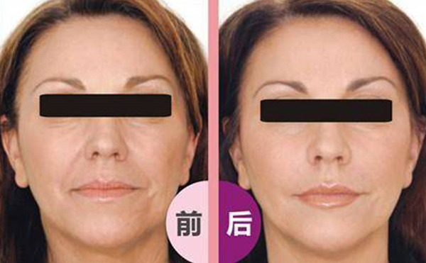 激光除皺會(huì)反彈嗎？