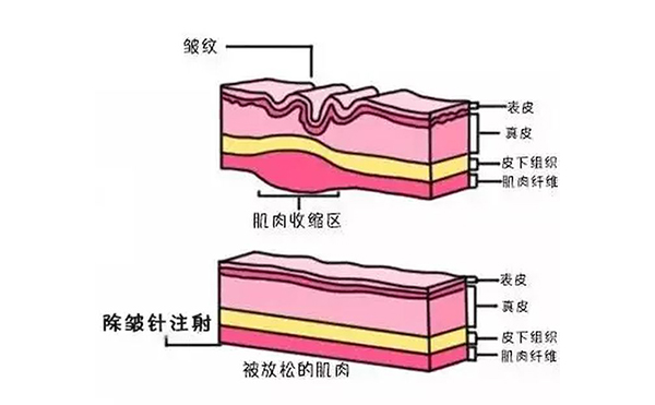 注射除皺是什么原理？